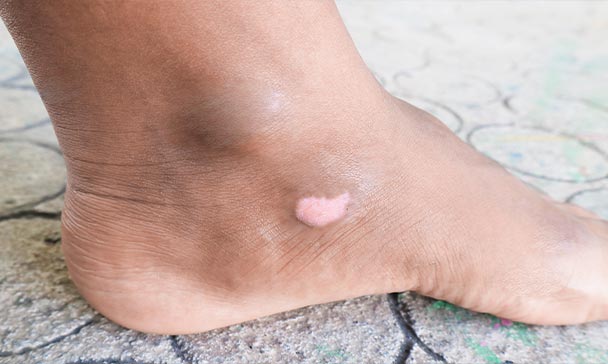 patient receiving wound care in Chicago